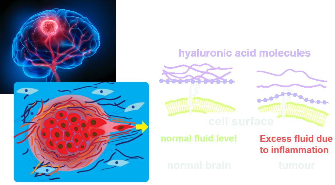 A glioblastoma in the brain, and hyaluronic acid molecules at the cell surface in normal brain at a normal fluid level, and in tumour with excess fluid due to inflammation