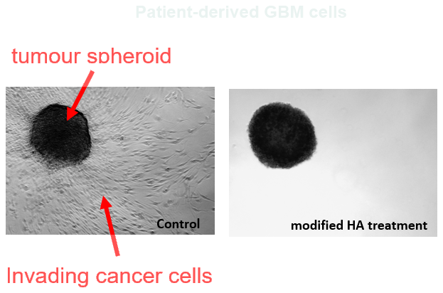 Patient-derived GBM cells: a control tumour spheroid with invading cancer cells, and a spheroid after modified HA treatment with none